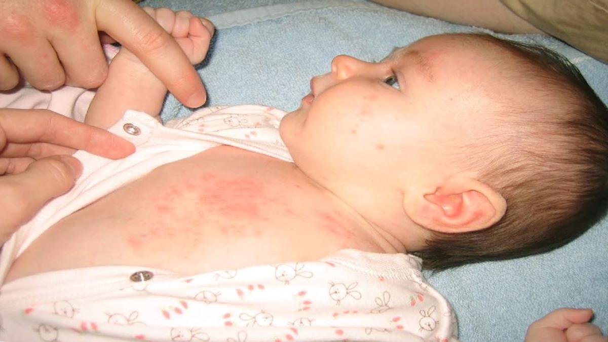 Опрелости у грудничков