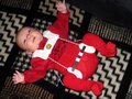Дисплазия тазобедренных суставов у детей