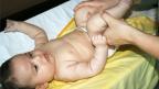 Лечение пупочной грыжи у ребенка